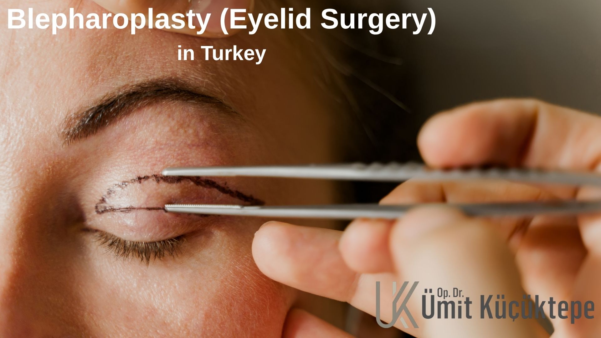 Blepharoplasty (Eyelid Surgery) in Turkey, Antalya Blepharoplasty (Eyelid Surgery) in Turkey, Antalya