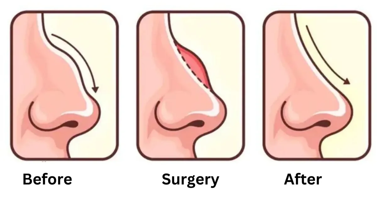 Soften Nasal Bridge-turkey-antalya