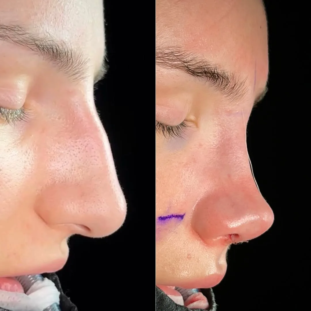 arched nose surgery in Turkey, Antalya?
