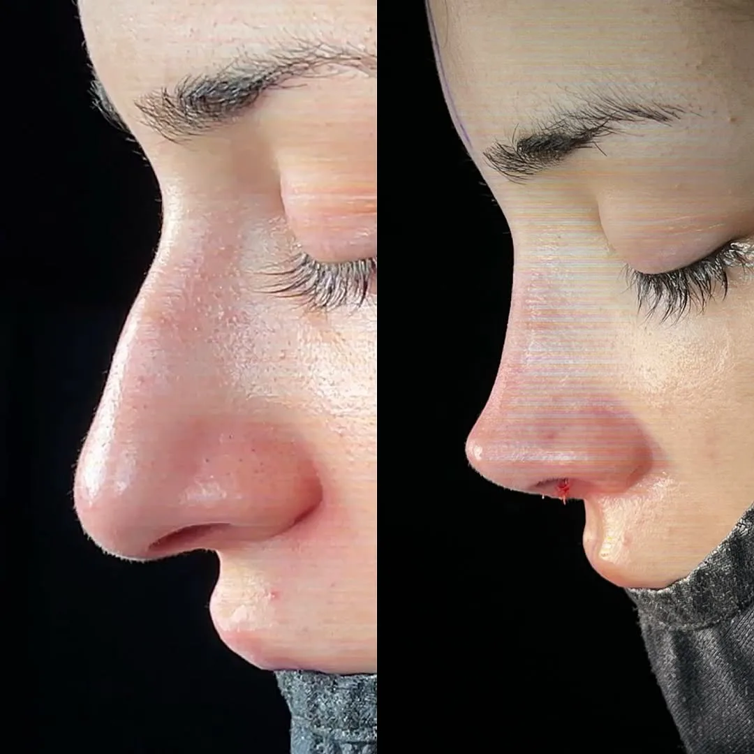 How is arched nose surgery performed in Turkey, Antalya?