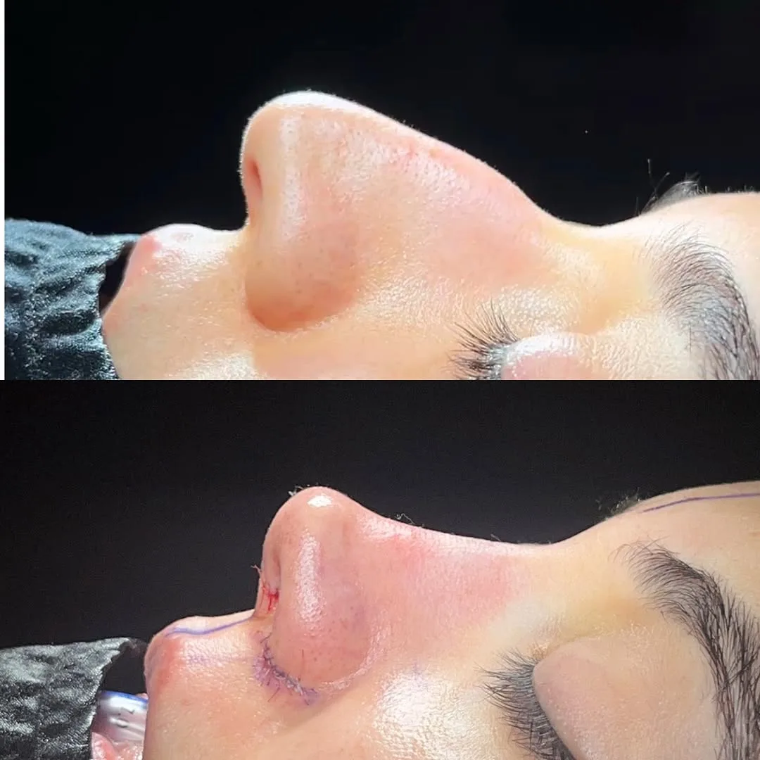 arched nose surgery before after
