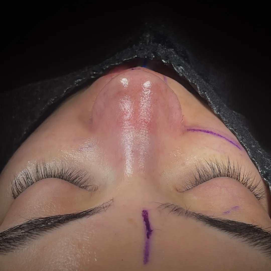 arched nose surgery before after-2