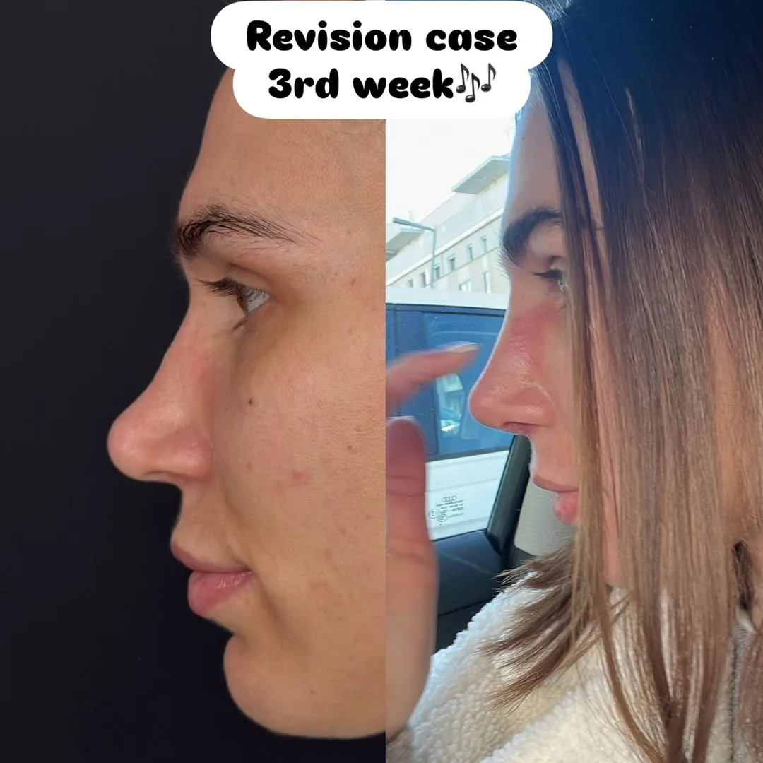 Revision Rhinoplasty with rip cartilage-1