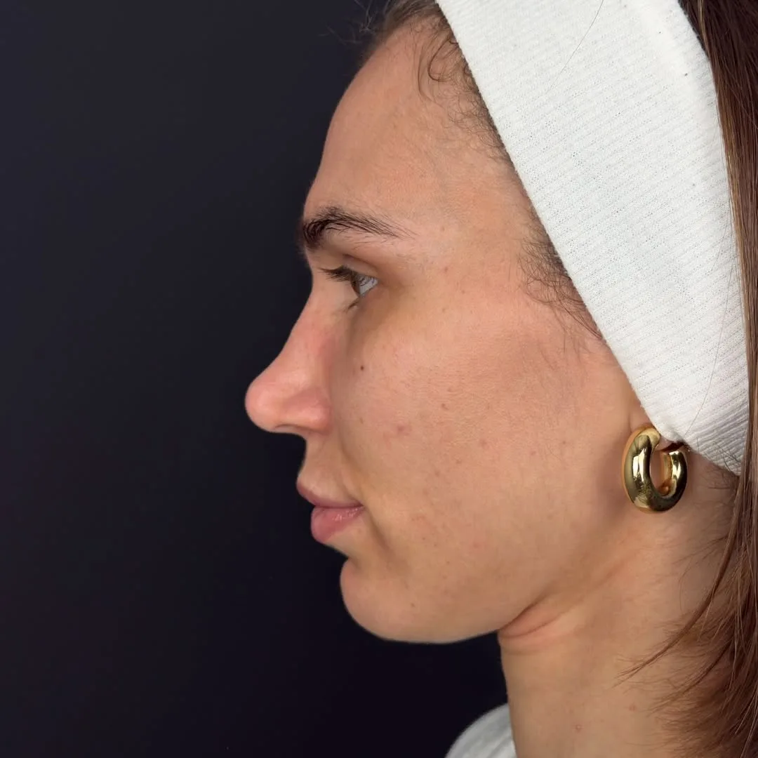 Revision Rhinoplasty with rip cartilage-2