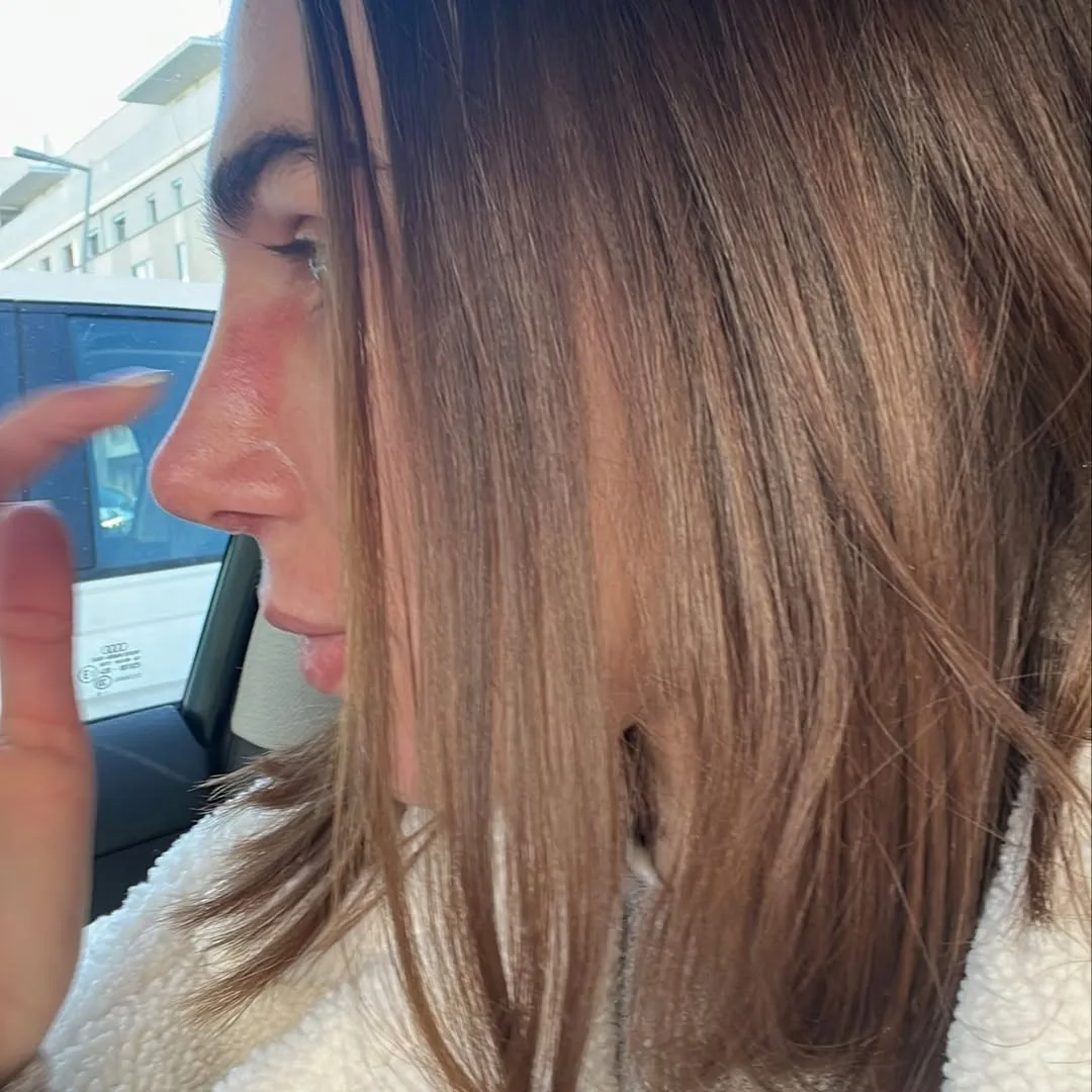 Revision Rhinoplasty with rip cartilage-3