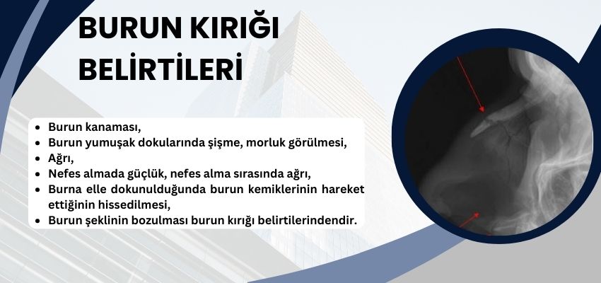 Burun kırığı belirtileri nelerdir? Antalya