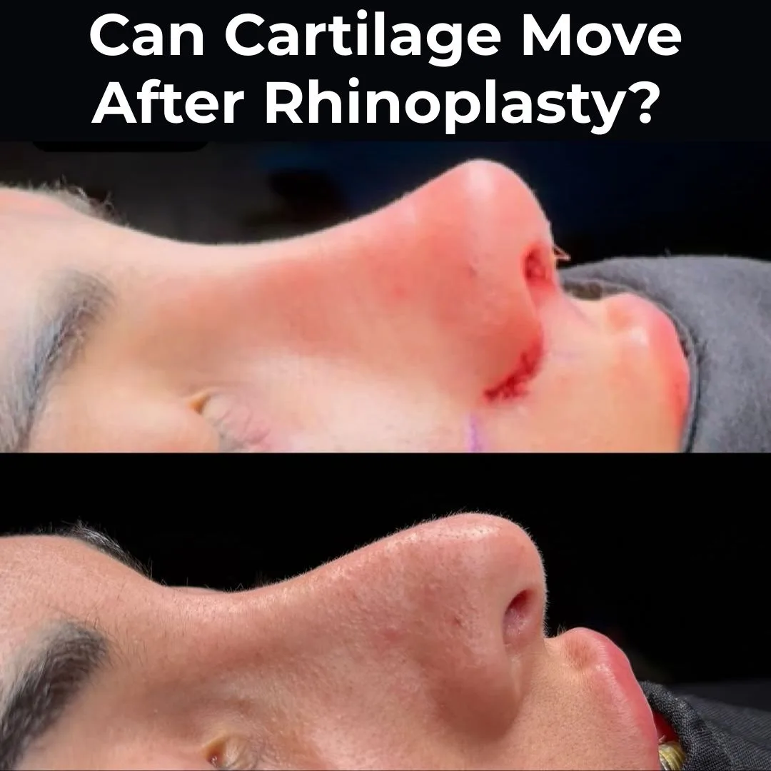 Can Cartilage Move After Rhinoplasty?  