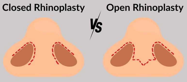 closed-rhinoplasty-open-rhinoplasty in Turkey, Antalya