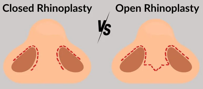closed-rhinoplasty-open-rhinoplasty in Turkey, Antalya