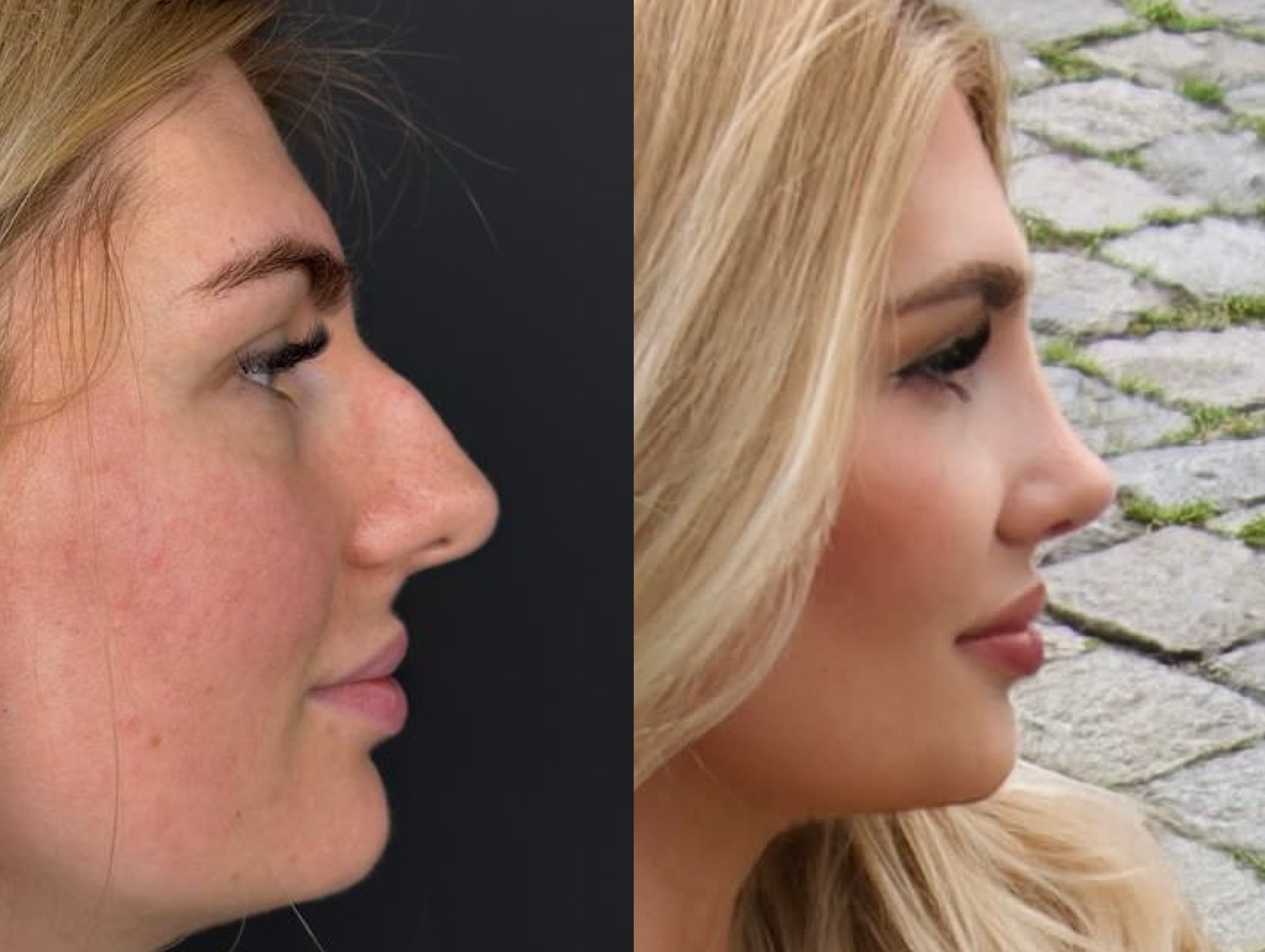 Rhinoplasty in Turkey, Antalya Rhinoplasty in Turkey, Antalya
