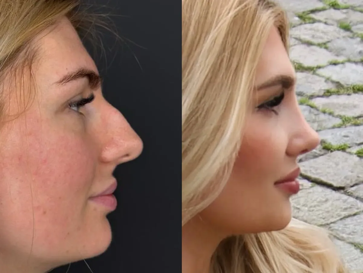 Rhinoplasty in Turkey, Antalya