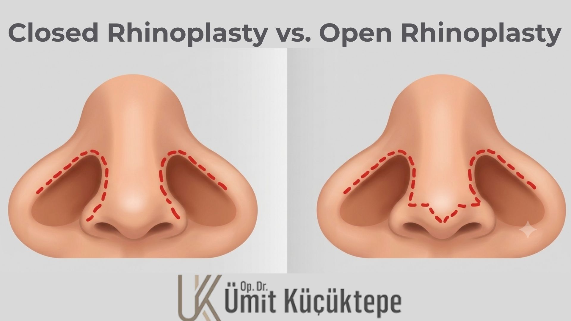 open-rhinoplasty-vs-closed-rhinoplasty-in-turkey