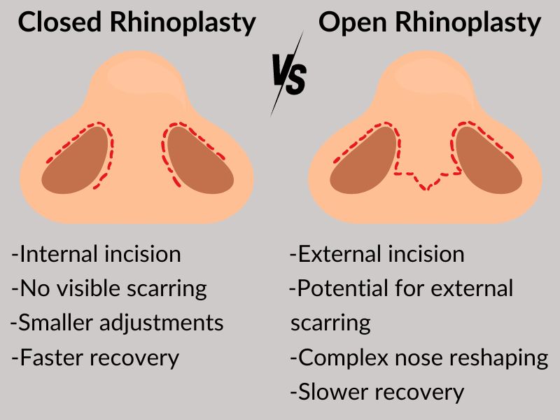 Closed Rhinoplasty vs Open Rhinoplasty