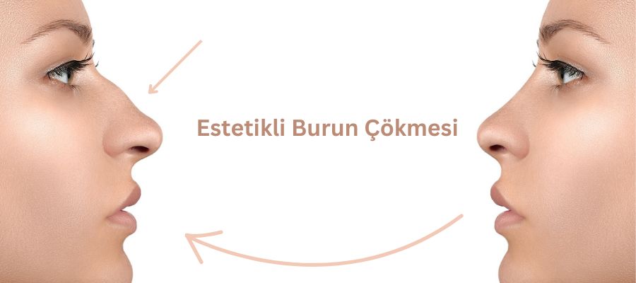 Estetikli burun çökmesi Antalya