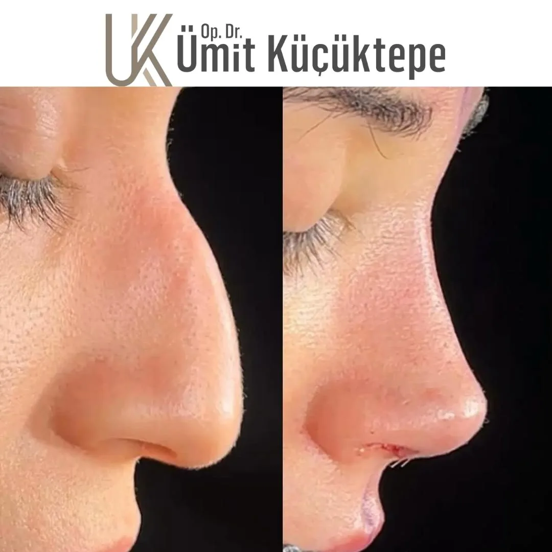 faq-in-rhinoplasty in turkey
