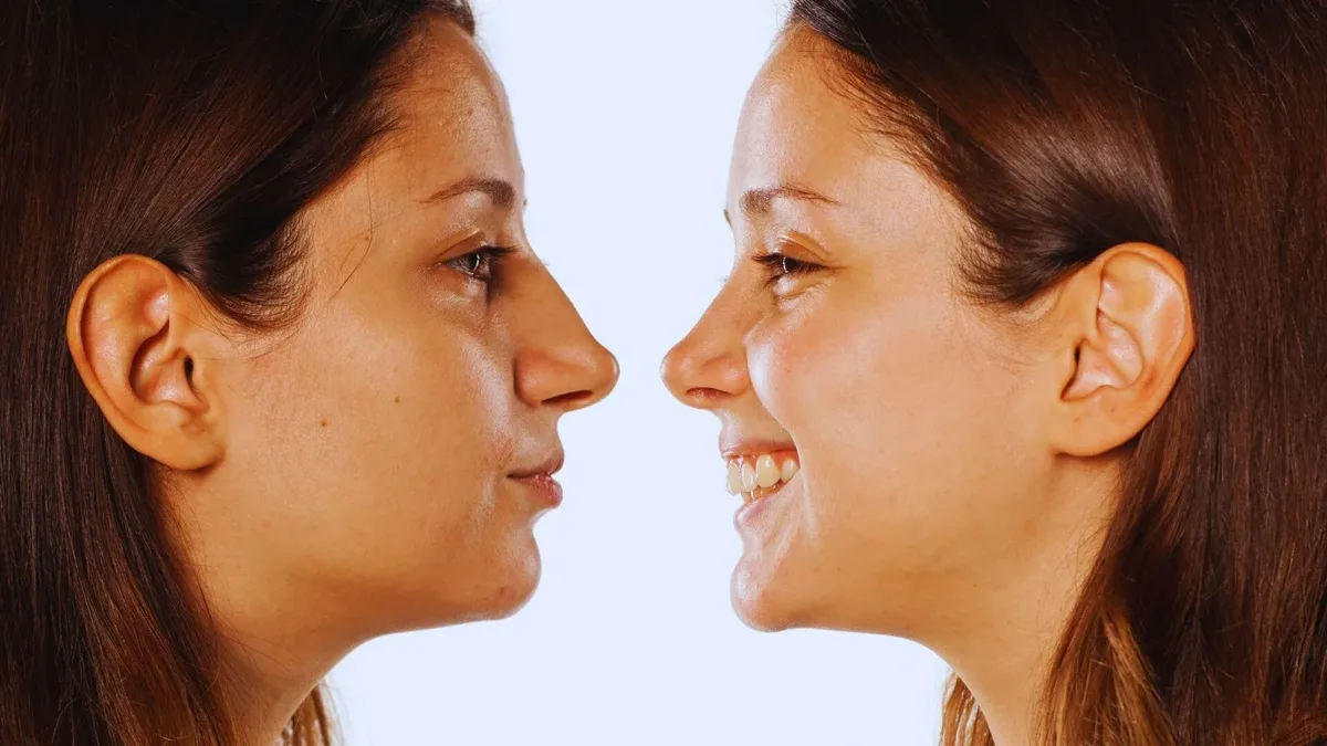 How Old Do You Have to be to Get Rhinoplasty? How Old Do You Have to be to Get Rhinoplasty?