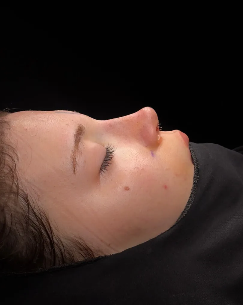Oblique view of the nose in a rhinoplasty case