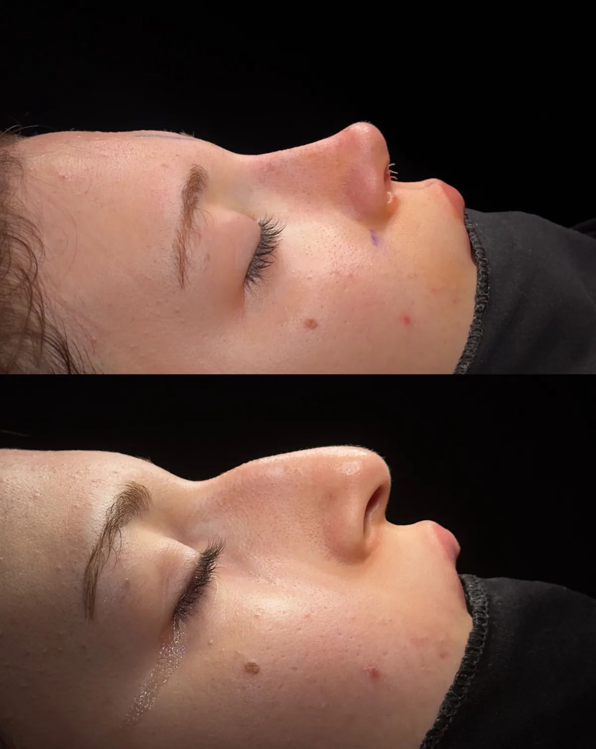 Paired side-profile photographs from a rhinoplasty case