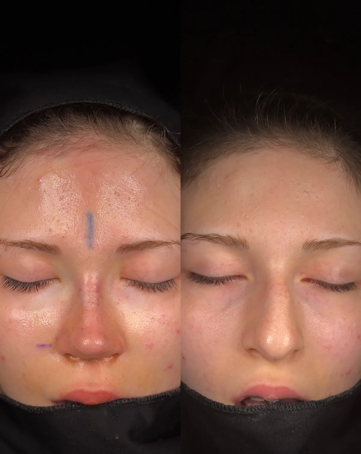 Paired front-view photographs showing nasal alignment