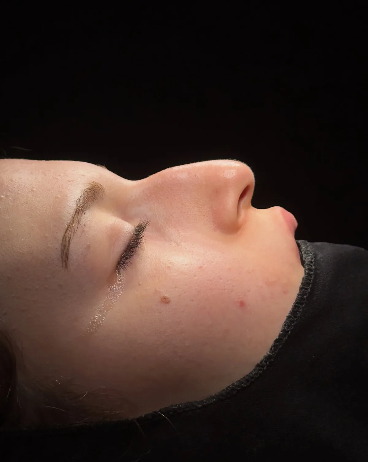 Side-profile photograph from a rhinoplasty case