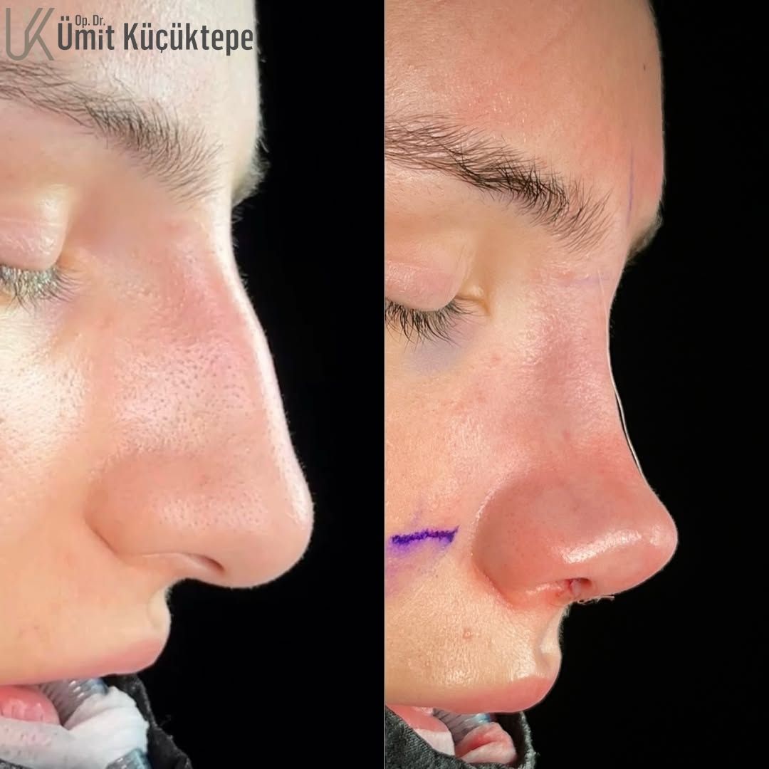 how-to-prepare-for-rhinoplasty-in-turkey-antalya