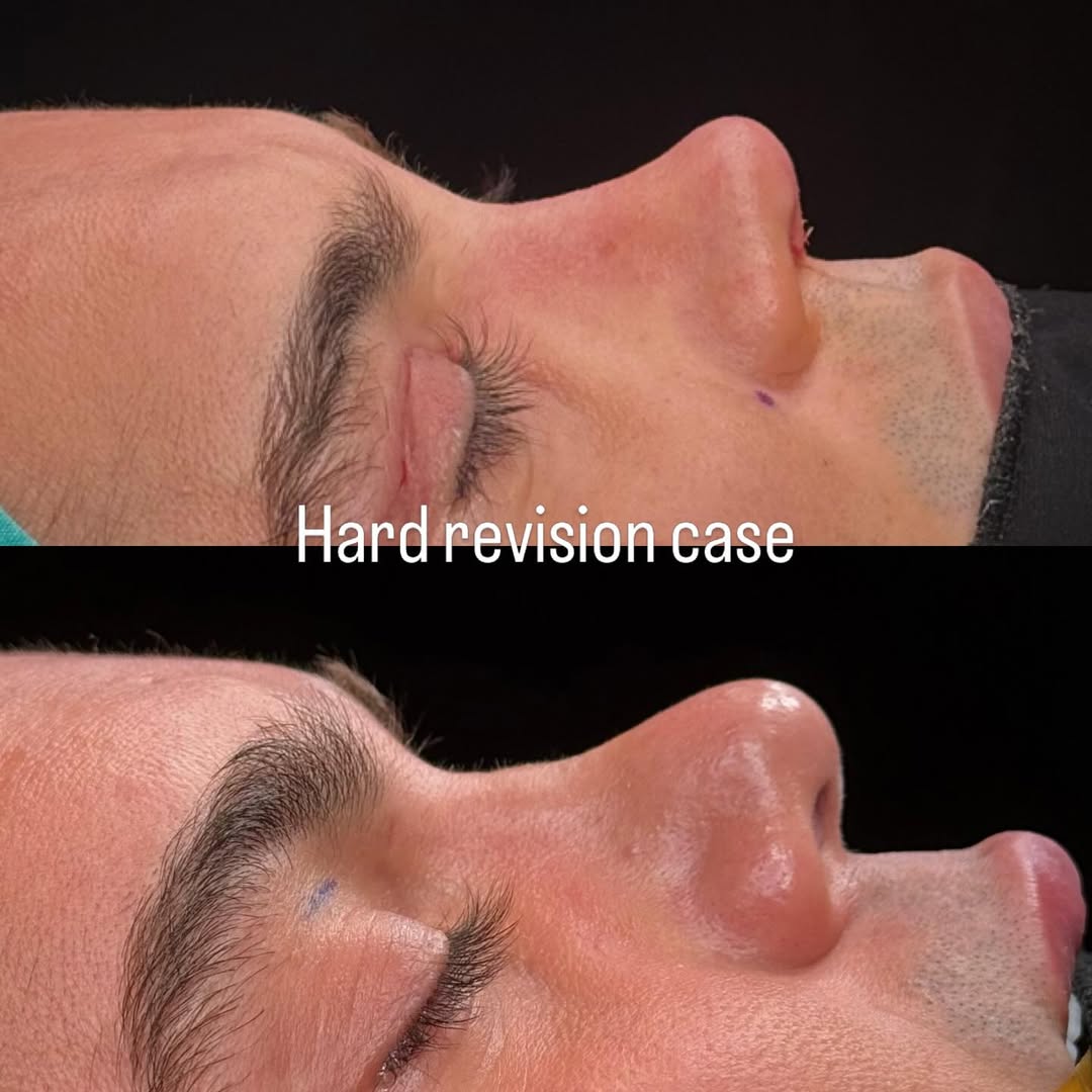 male-rhinoplasty-turkey-antalya-before-after-1