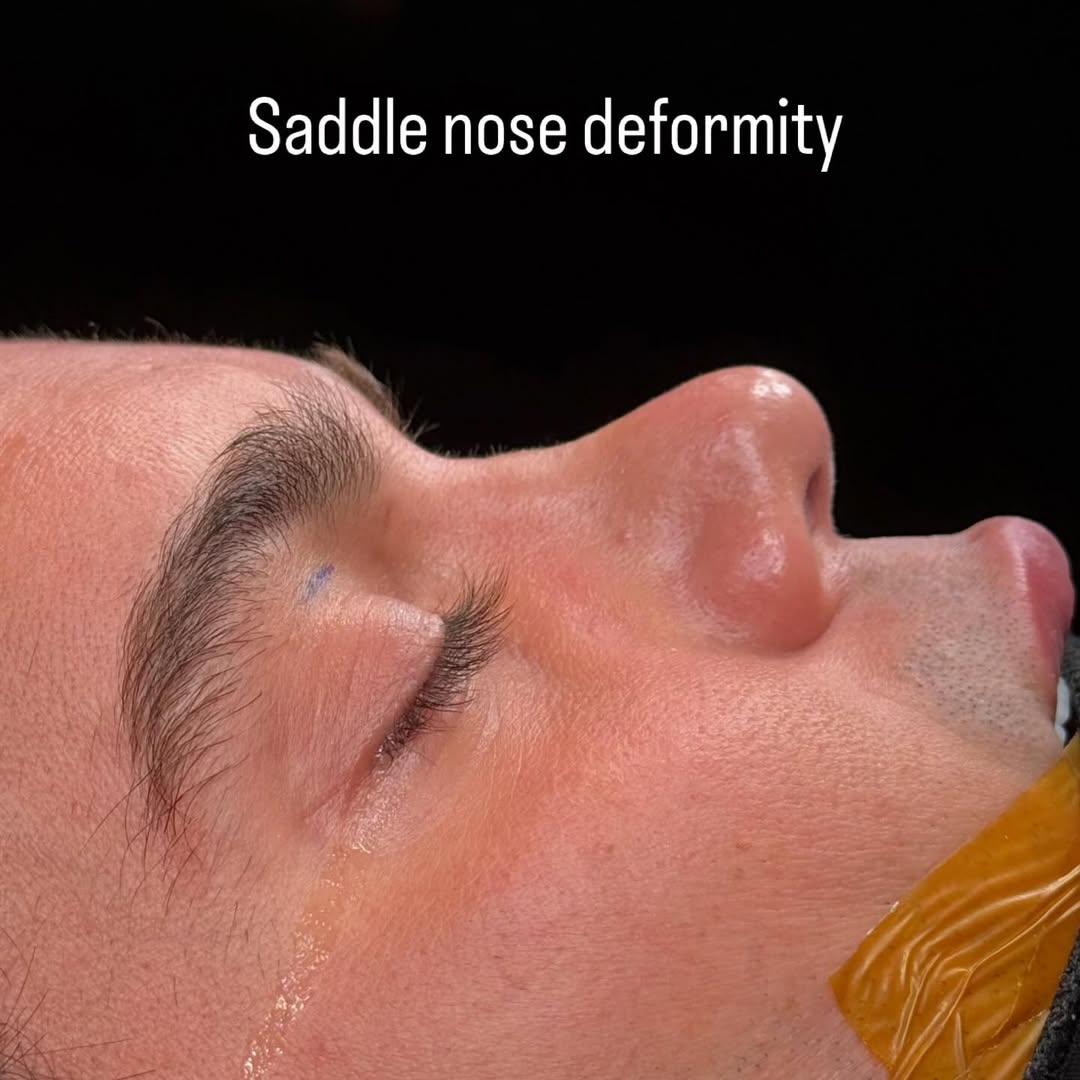 male-rhinoplasty-turkey-antalya-before-after-2