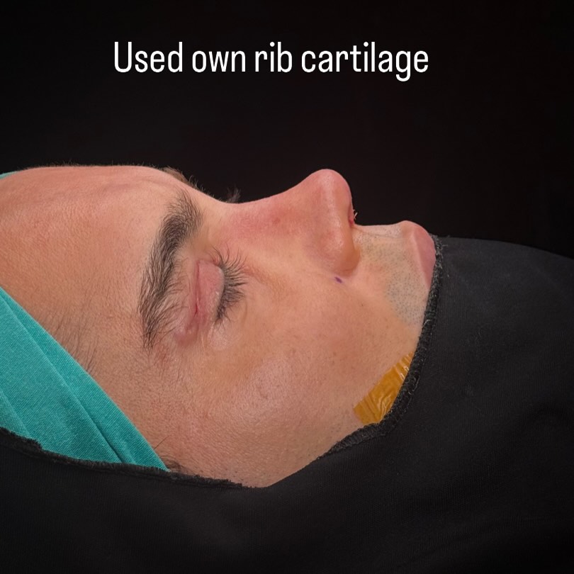 male-rhinoplasty-turkey-antalya-before-after-3