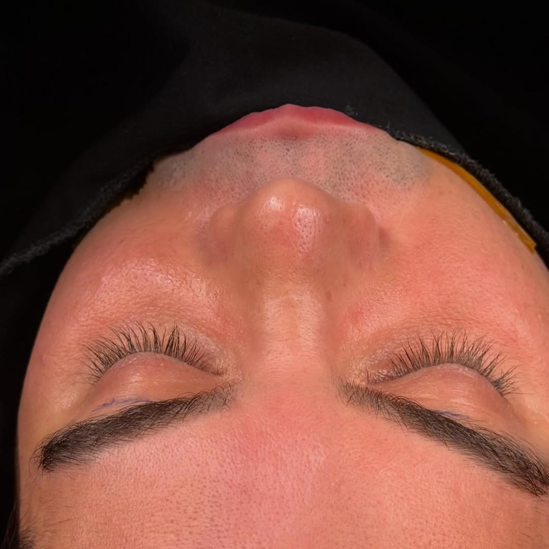 male-rhinoplasty-turkey-antalya-before-after-4