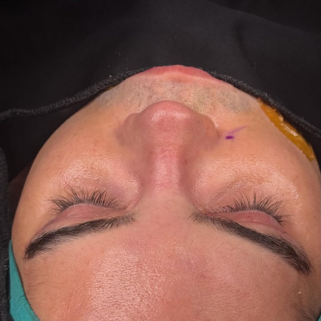 male-rhinoplasty-turkey-antalya-before-after-5