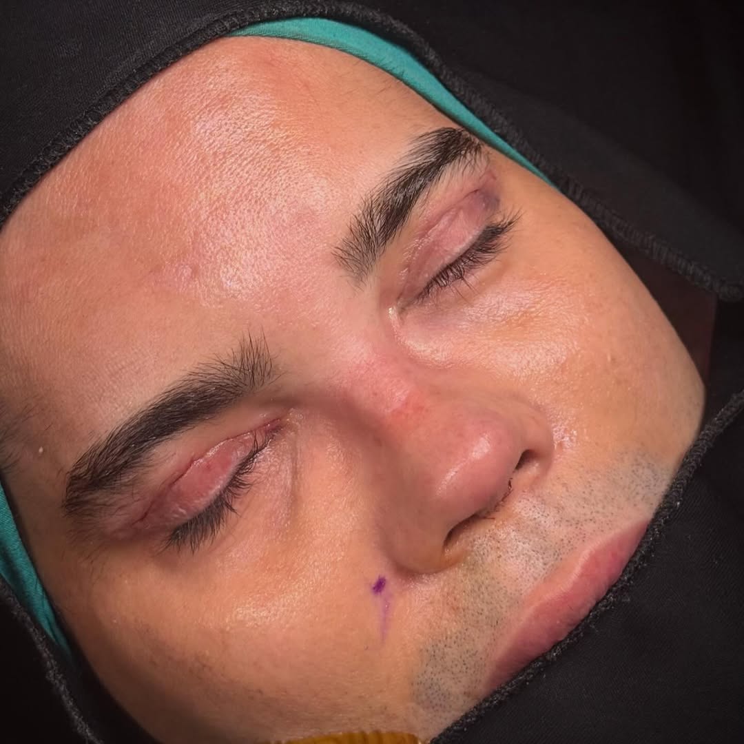male-rhinoplasty-turkey-antalya-before-after-7
