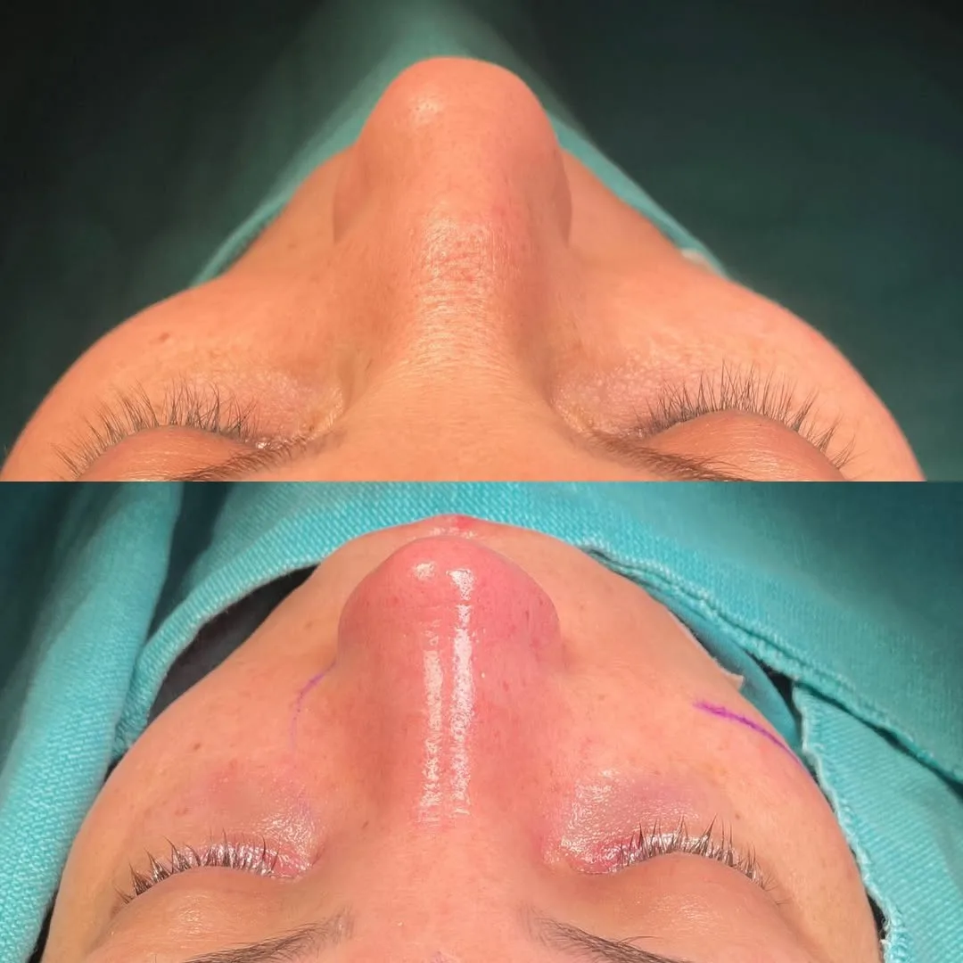 nasal bone curvature before after