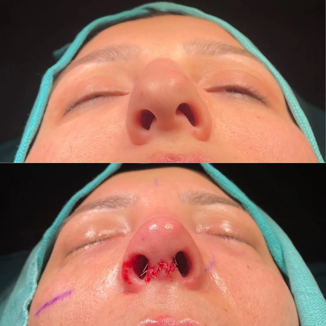 nasal bone curvature before after-1
