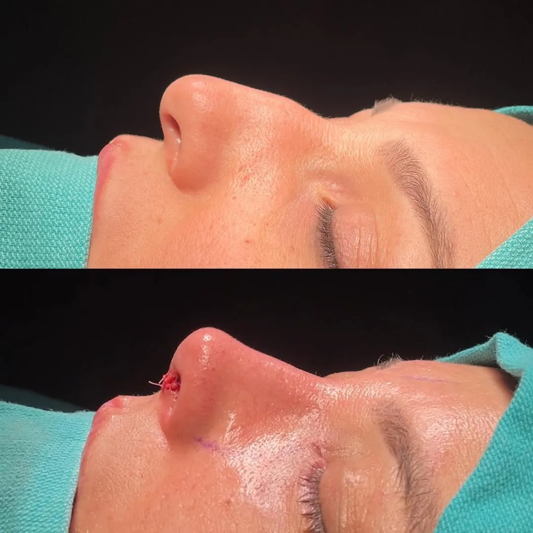 nasal bone curvature before after-2