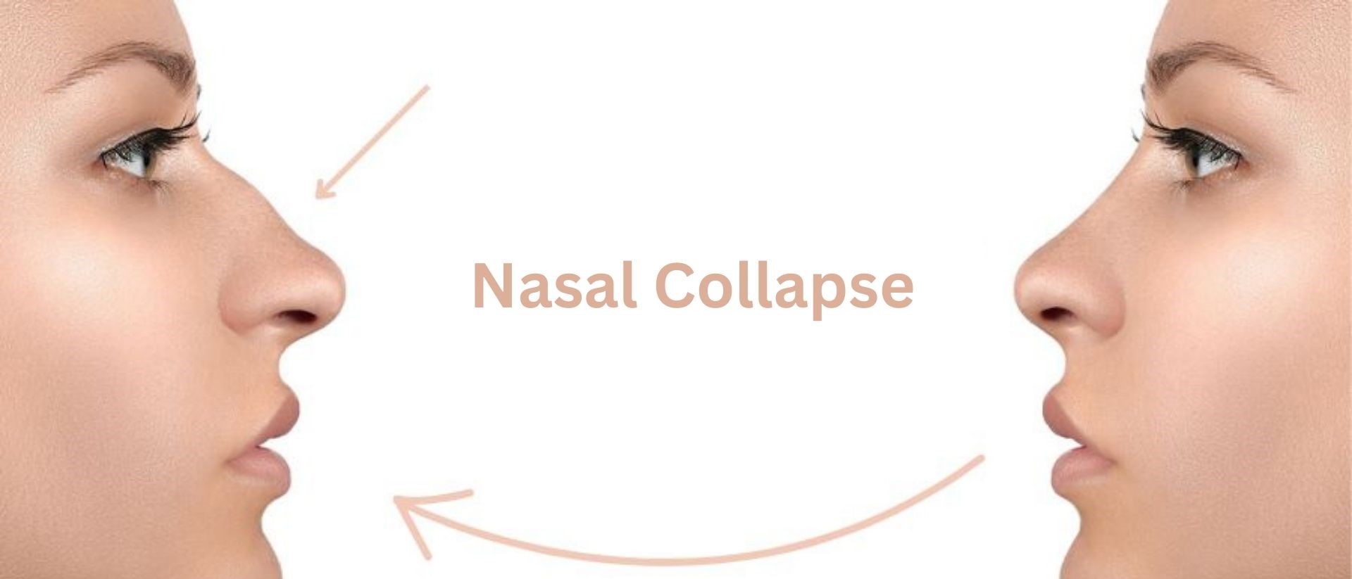 nasal-collapse-after-rhinoplasty-turkey-antalya