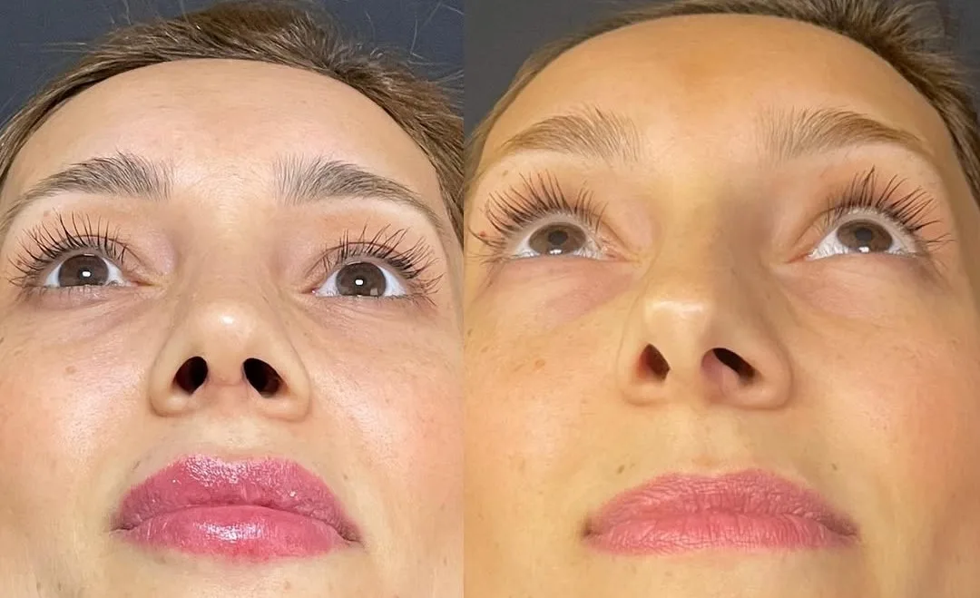 Is nasal bone curvature (deviated septum) a serious issue? in Turkey Antalya