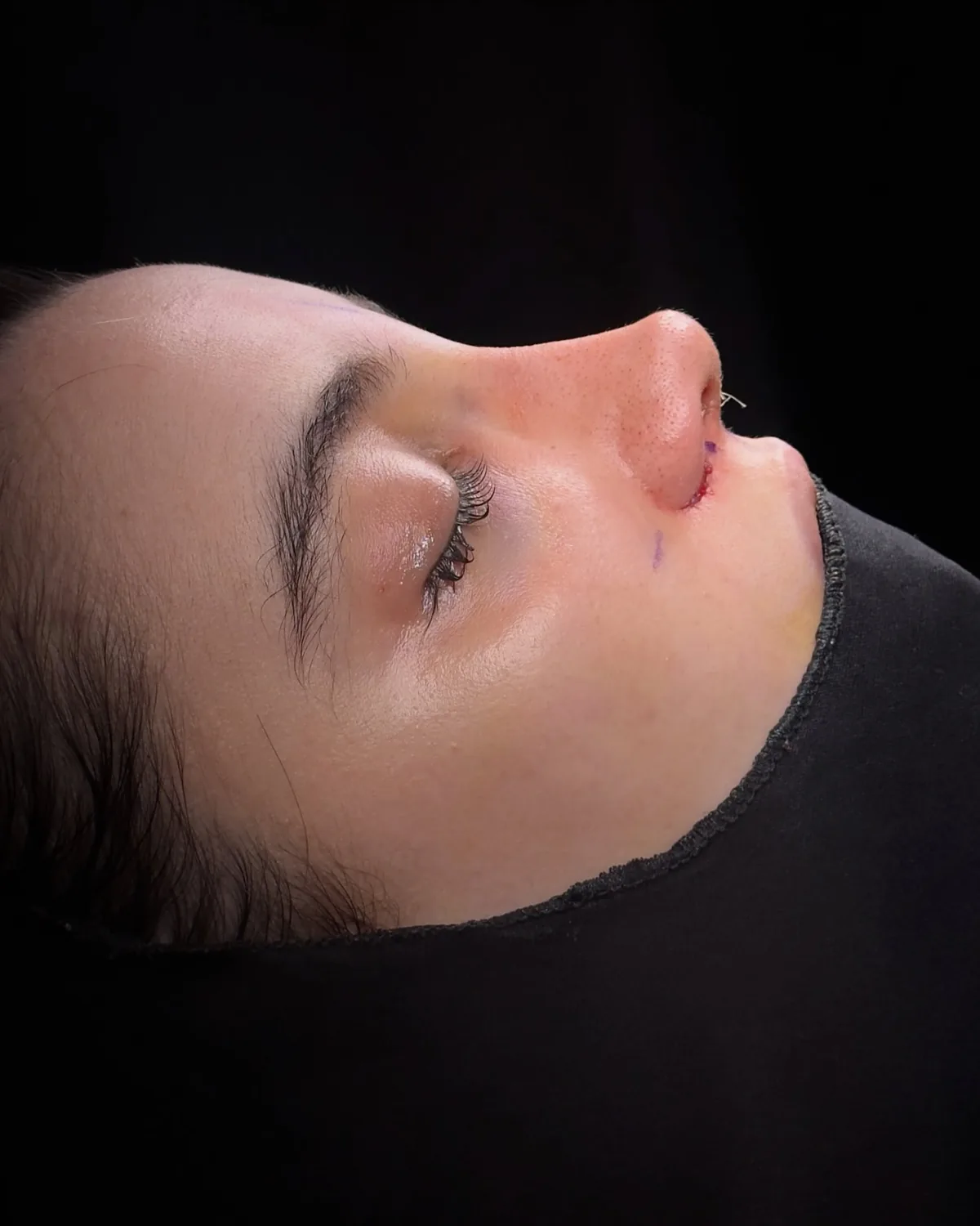 Side profile of the nose at the end of dorsal hump reduction surgery