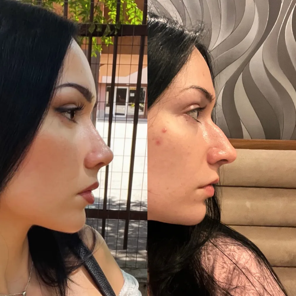 Nasal hump removal before and after: side profile after surgery (left) and before surgery (right)