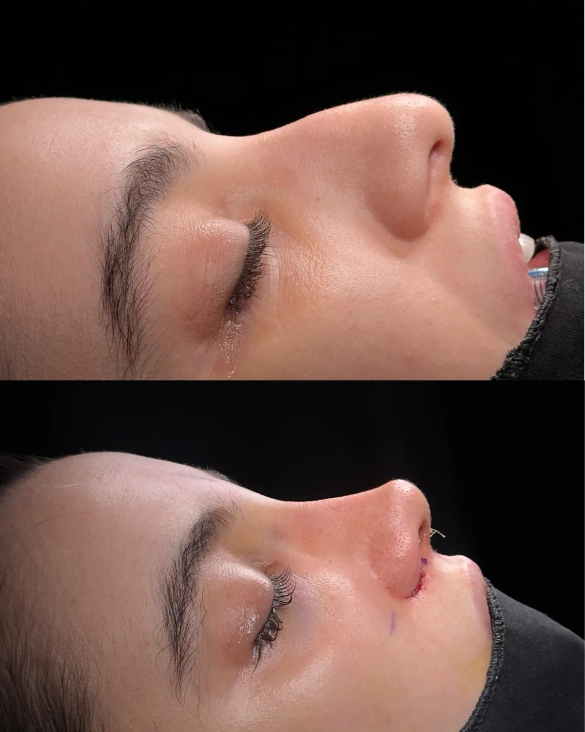 Side-profile photographs before and at the end of nasal hump removal surgery