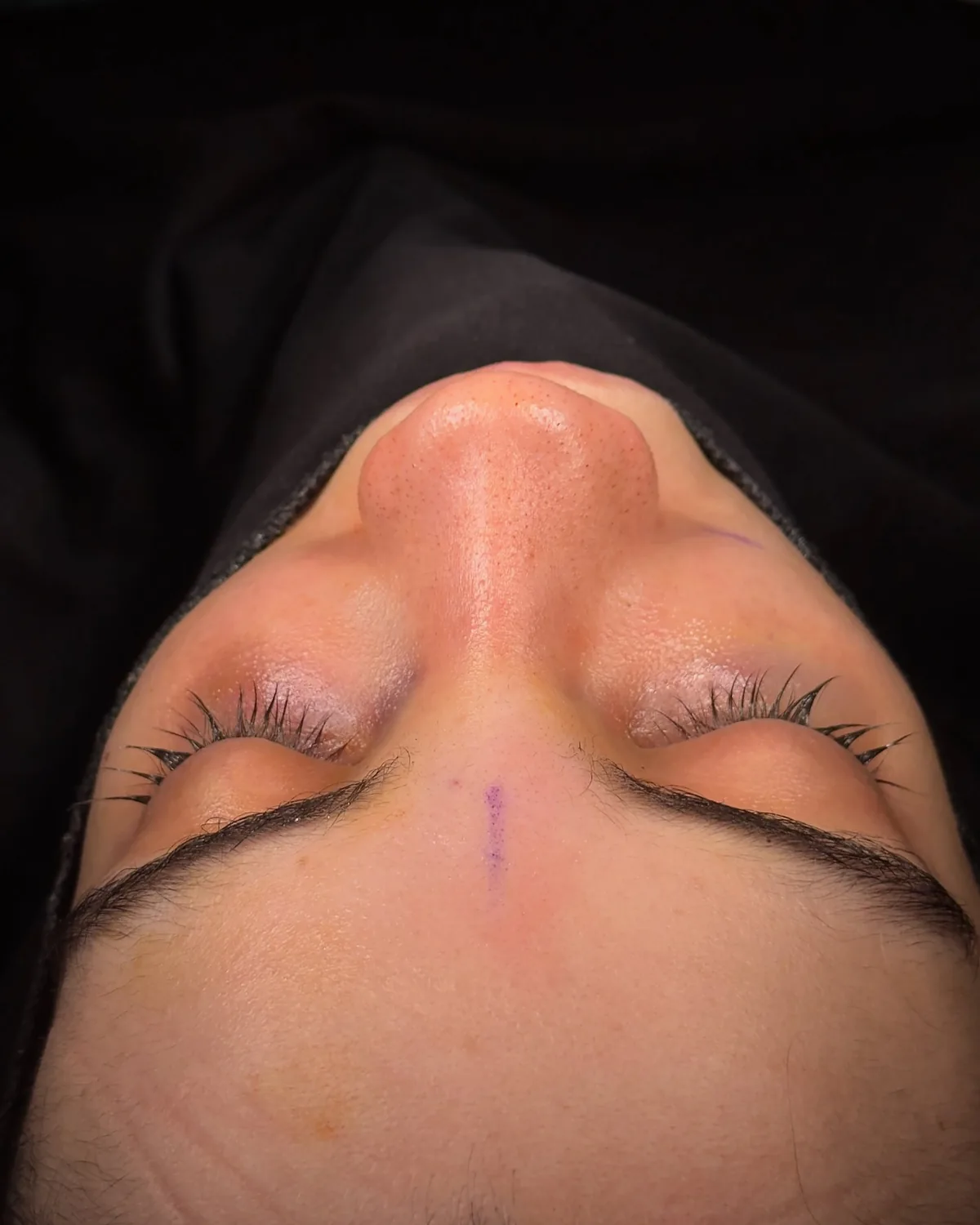 View along the nasal bridge at the end of nasal hump removal surgery