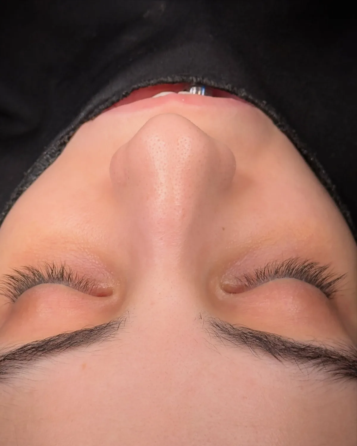 View along the nasal bridge before nasal hump removal surgery