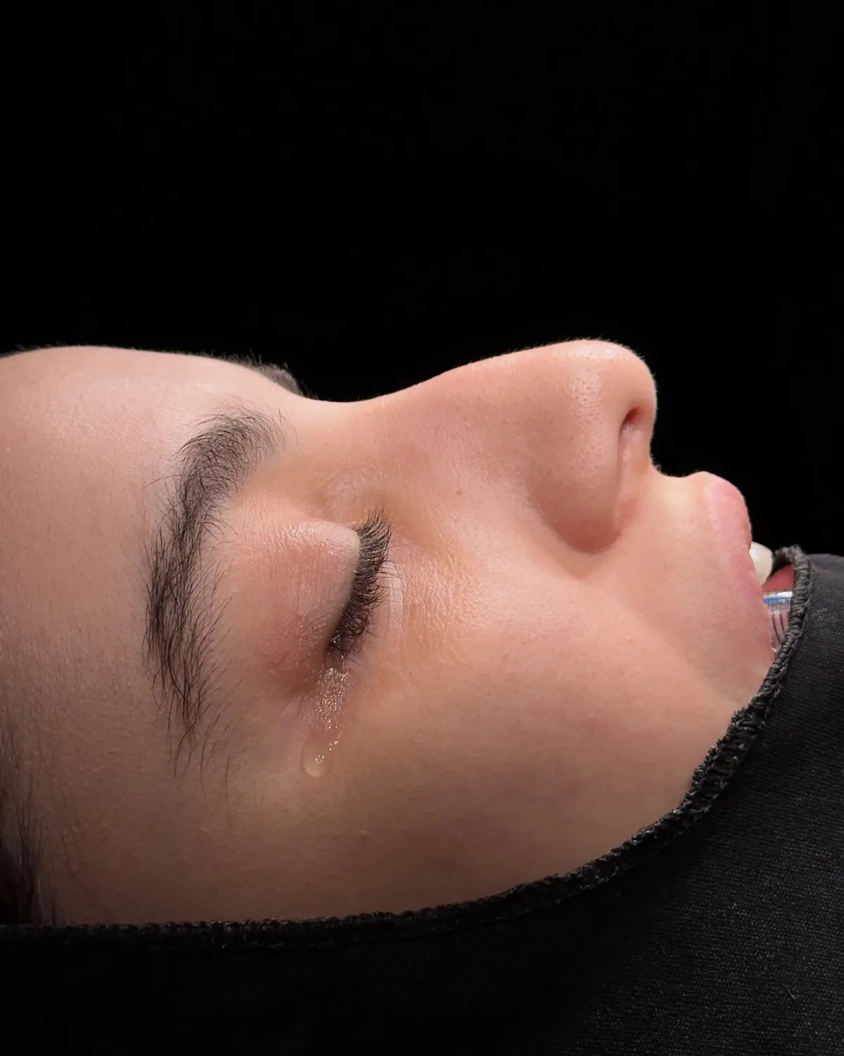 Side profile showing a dorsal hump on the bridge of the nose before surgery