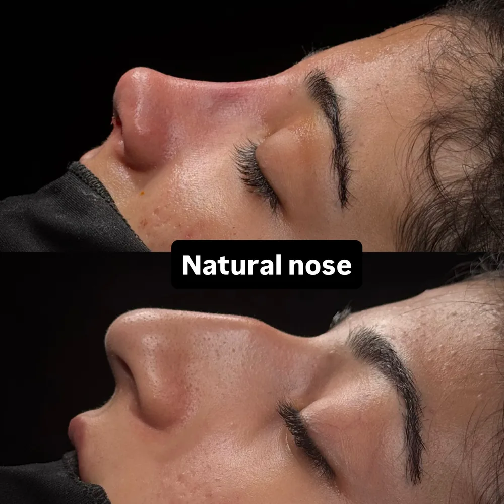 Side-profile photographs of the nose in the early healing period and after the swelling has settled