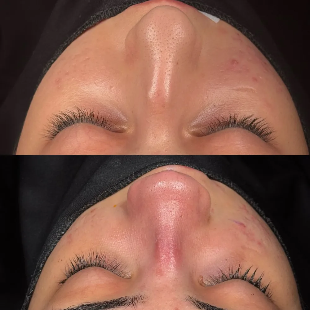 View along the nasal bridge after the swelling has settled and in the early healing period