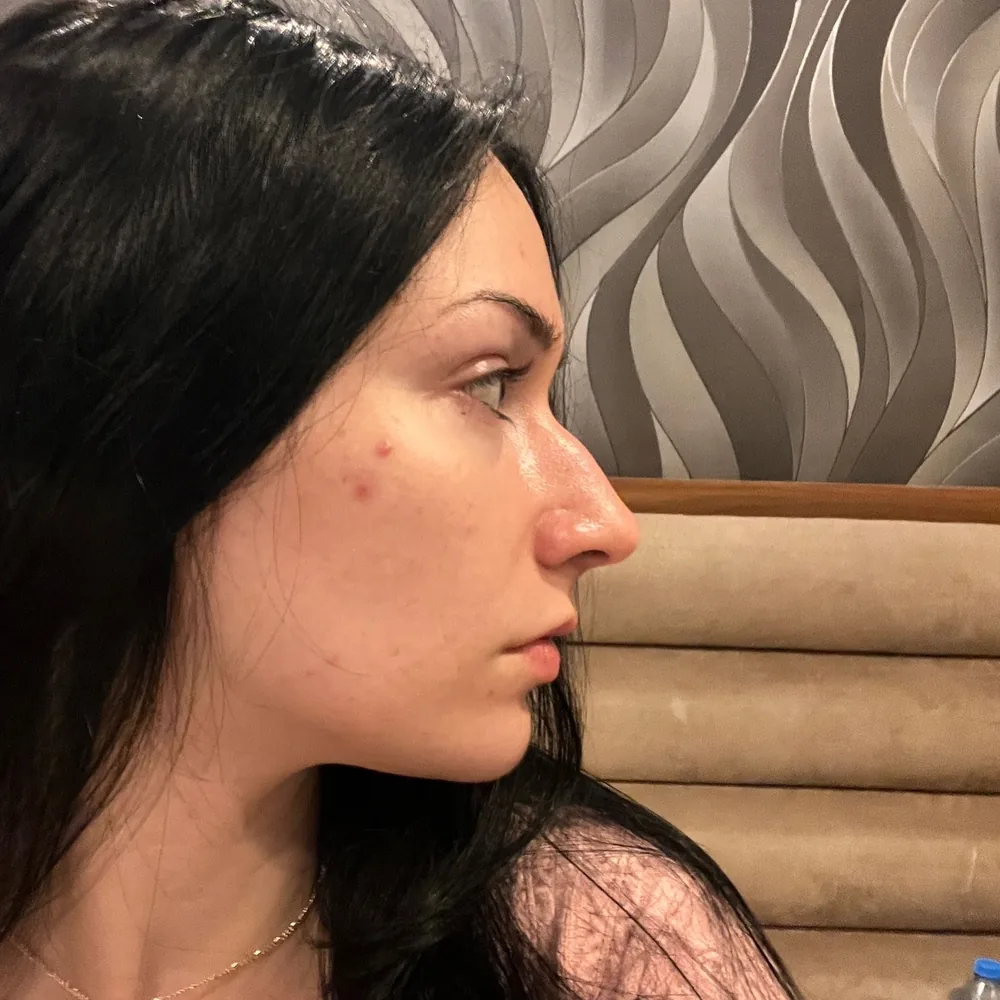 Side profile before surgery showing a dorsal hump on the bridge of the nose