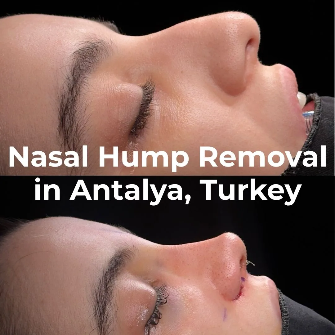 Nasal hump removal in Antalya, Turkey - side profile before and during dorsal hump reduction