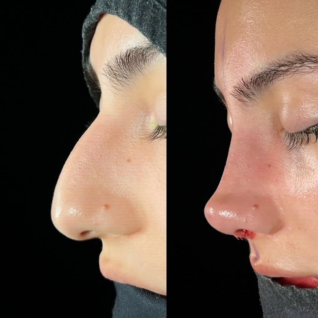 natural-nose-13