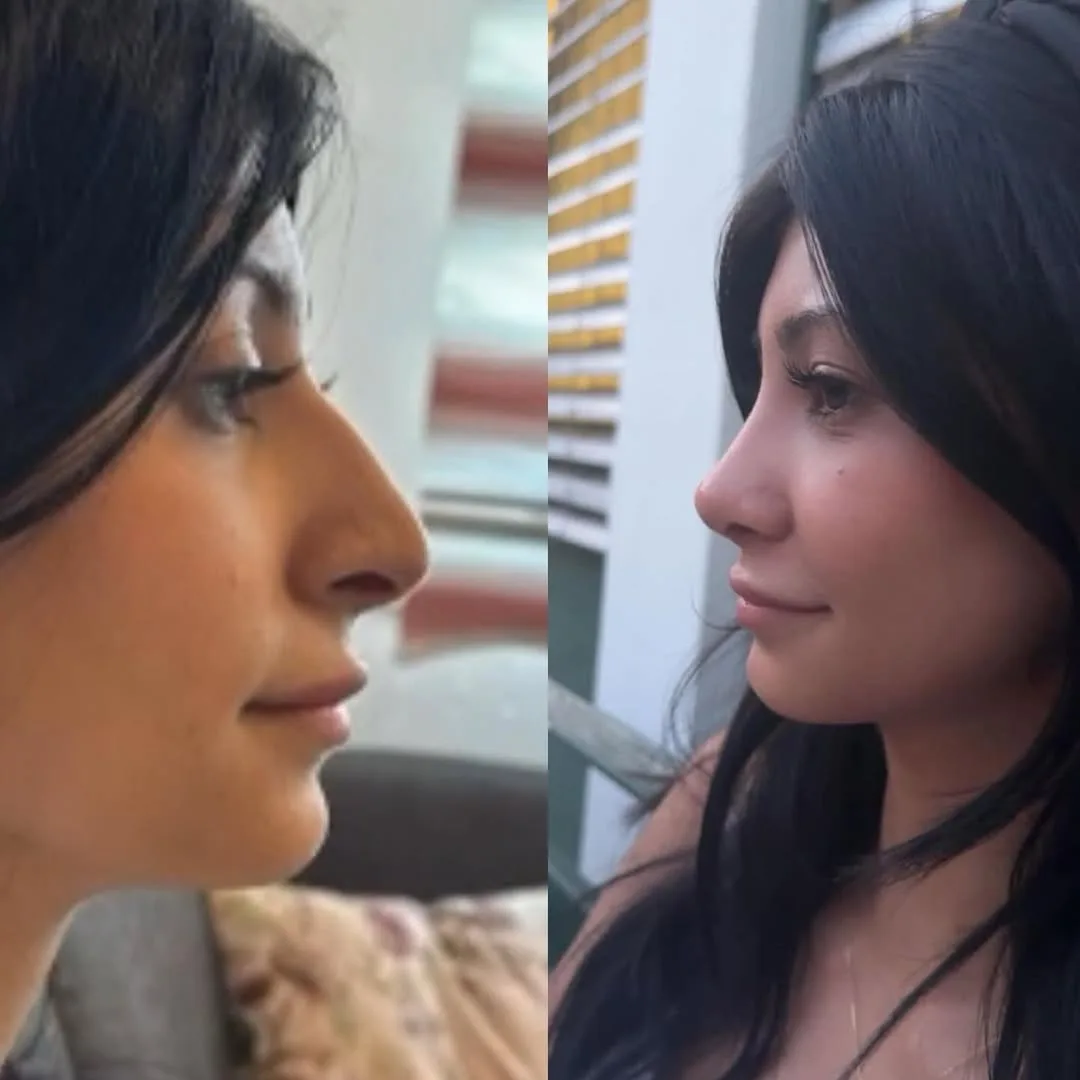 natural-nose-14