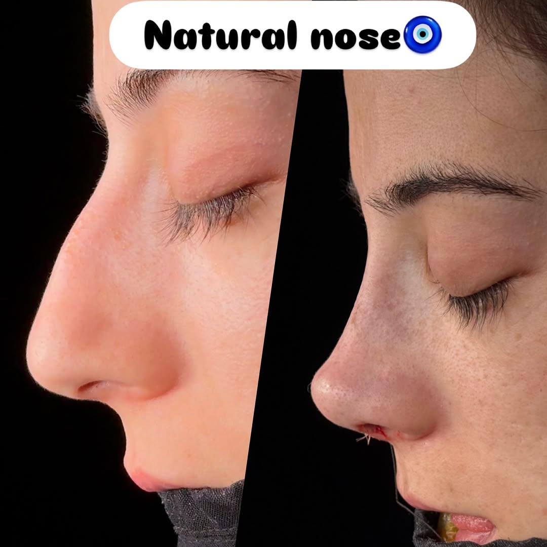 natural-nose-16