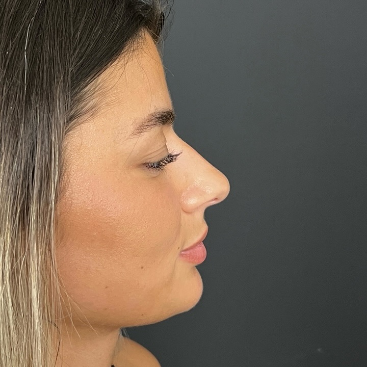natural-nose-2